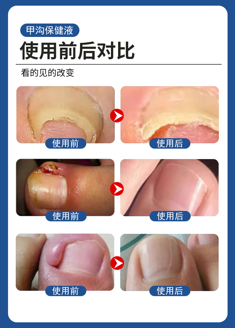 甲沟炎专用液有用吗？使用前后对比